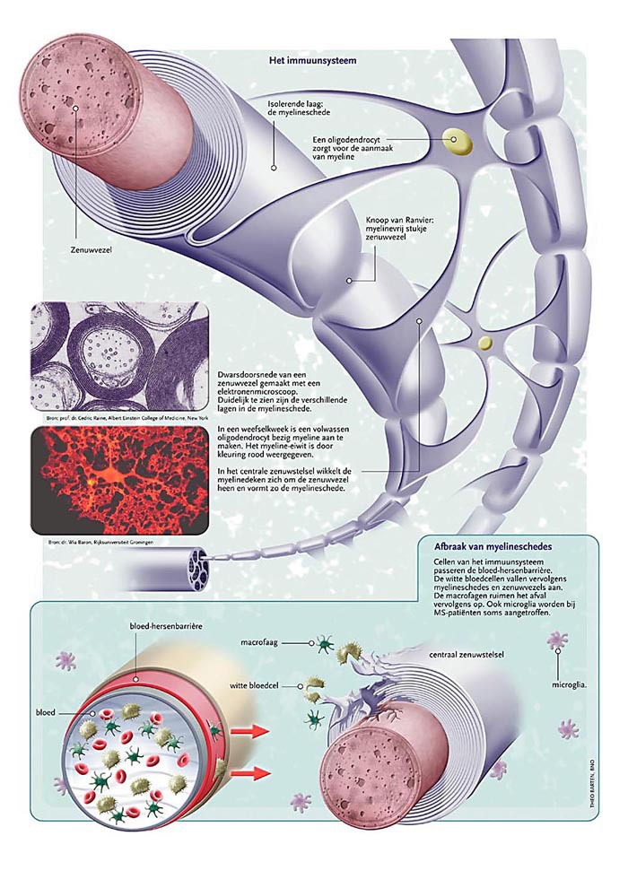 Infographic: Afbraak van het immuunsysteem Afbraak van het immuunsysteem